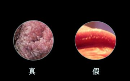 尖锐湿疣潜伏期症状,尖锐湿疣潜伏期的早期迹象与预防措施